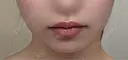 ボトックス（口角） TCB東京中央美容外科 京都駅前院 BEFORE サムネイル用