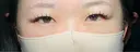 二重埋没 / 上まぶたの脂肪取り アリエル美容クリニック 大宮院 BEFORE サムネイル用