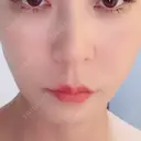 ボトックス（あご） / ボトックス（エラ・小顔） / ボトックス（口角） / ボトックス（人中） DMTC CLINIC 渋谷院 BEFORE サムネイル用