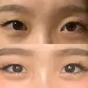 二重埋没 札幌中央形成外科 BEFORE サムネイル用