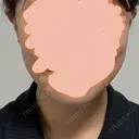 糸リフト / バッカルファット除去 / 脂肪吸引（顔） First Clinic BEFORE サムネイル用