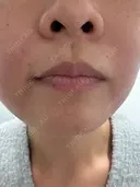 ショッピングリフト 東京シンデレラ美容外科 新宿院 BEFORE サムネイル用