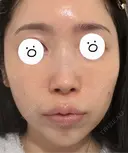 糸リフト 湘南美容クリニック 大阪京橋院 BEFORE サムネイル用