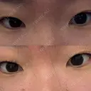 二重埋没 共立美容外科 大宮院 BEFORE サムネイル用