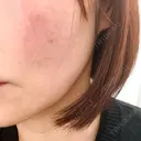 その他（輪郭） ルラ美容クリニック 大宮院 / ルラスキンクリニック 大宮院 BEFORE サムネイル用