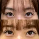 二重埋没 / 糸リフト / ヒアルロン酸注入（あご） ネビュラクリニック 京都院 BEFORE サムネイル用