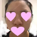 鼻中隔延長（切開） / 小鼻縮小（切開） / 軟骨移植 / 鼻尖縮小 / 鼻孔縁下降 / その他（鼻） 加美（GAMI）整形外科 BEFORE サムネイル用