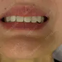 ボトックス（エラ・小顔） / ボトックス（眉間） / ボトックス（目尻） / ボトックス（額） ルラ美容クリニック 郡山院 BEFORE サムネイル用