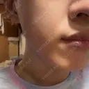 白玉点滴・注射 / ピコスポット 東京シルククリニック 新宿院 BEFORE サムネイル用