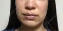 オンダリフト RIVER CLINIC（リバークリニック） BEFORE サムネイル用