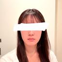 その他（輪郭） / ボトックス（エラ・小顔） 大美会クリニック 心斎橋本院 BEFORE サムネイル用