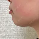ボトックス（あご） / ヒアルロン酸注入（あご） / ボトックス（エラ・小顔） Next Tokyo Clinic BEFORE サムネイル用