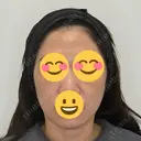 糸リフト / ヒアルロン酸注入（鼻翼基部） Olivia Clinic BEFORE サムネイル用