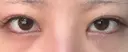 ヒアルロン酸注入（涙袋） 吉祥寺アイビークリニック BEFORE サムネイル用