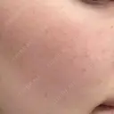 ルメッカ 大美会クリニック 京都烏丸院 BEFORE サムネイル用