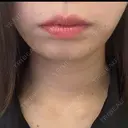 ボトックス（あご） / 肌ヒアルロン酸注入（たるみ・シワ改善） BIZENNクリニック【ビゼンクリニック】 BEFORE サムネイル用