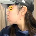 その他（輪郭） / イオン導入 ルラ美容クリニック 仙台院 / ルラスキンクリニック 仙台院 BEFORE サムネイル用