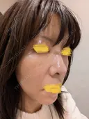 毛穴洗浄（ハイドラフェイシャルなど） Zetith Beauty Clinic 池袋院 BEFORE サムネイル用