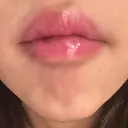 ボトックス（あご） / ボトックス（口角） ルラ美容クリニック 岐阜院 BEFORE サムネイル用