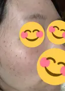 肌育注射（ジュベルックなど） 大美会クリニック 京都烏丸院 BEFORE サムネイル用