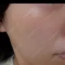 ピーリング（ハリ・ツヤ） / ルメッカ 大美会クリニック 梅田院 BEFORE サムネイル用