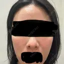 ジャルプロ ウィルビークリニック 新宿院 BEFORE サムネイル用