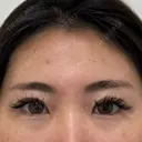 二重埋没 / 目頭切開 / 目尻切開 / タレ目形成・グラマラスライン（切開） / 目尻靭帯移動 BITO BEAUTY CLINIC BEFORE サムネイル用