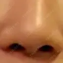 小鼻縮小（切開） EMMO FACE CLINIC 東京三田院 BEFORE サムネイル用