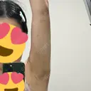 インディバ（二の腕） 渋谷美容外科クリニック 横浜院 BEFORE サムネイル用