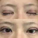 二重埋没 / 上まぶたの脂肪取り アリエル美容クリニック 郡山院 BEFORE サムネイル用