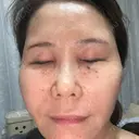 水光注射（ハリ・美肌） / ハイフ（首） しんゆり美容健康クリニック BEFORE サムネイル用