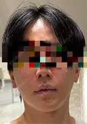 糸リフト / 脂肪吸引（顔） / 脂肪注入（額） / ボトックス（エラ・小顔） / ボトックス（口角） / 脂肪注入（輪郭） / その他（輪郭） 4Dクリニック BEFORE サムネイル用