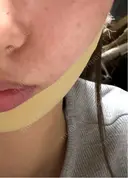 糸リフト / 脂肪吸引（顔） / 水光注射（ハリ・美肌） Wing clinic 豊中駅前院 BEFORE サムネイル用