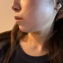 ボトックス（エラ・小顔） / インモード Moon Beauty Clinic BEFORE サムネイル用