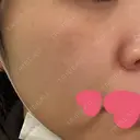 イオン導入 / 医療脱毛（顔） / ピーリング（ハリ・ツヤ） / ルメッカ ルラ美容クリニック 広島院 BEFORE サムネイル用