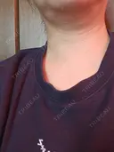 ハイフ（首） アクティブエイジクリニック BEFORE サムネイル用