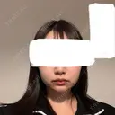 ハイフ（顔） / オンダリフト Ledian Clinic六本木 BEFORE サムネイル用