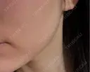 脂肪吸引注射（顔） APスキンクリニック銀座 BEFORE サムネイル用