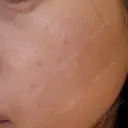 水光注射（ハリ・美肌） / 毛穴洗浄（ハイドラフェイシャルなど） RIN BEAUTY CLINIC BEFORE サムネイル用