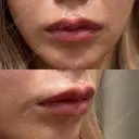 ヒアルロン酸注入（唇） HAAB BEAUTY CLINIC 名古屋院 BEFORE サムネイル用