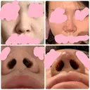 隆鼻術 / ヒアルロン酸注入（鼻） 東京ヒルズクリニック 新宿院 BEFORE サムネイル用