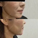 糸リフト / 脂肪吸引（顔） 脂肪吸引ラボトウキョウ BEFORE サムネイル用
