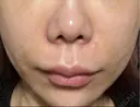 脂肪溶解注射（顔） ルラ美容クリニック 岡山院 BEFORE サムネイル用