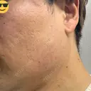 ボトックス（エラ・小顔） BiBiクリニック BEFORE サムネイル用