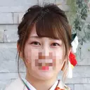 二重埋没 / バッカルファット除去 / 脂肪吸引（顔） / ヒアルロン酸注入（あご） / ボトックス（エラ・小顔） / 美容点滴・美容注射（美肌） エートップ美容整形外科 BEFORE サムネイル用