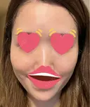 脂肪注入（肌） 日本ウェルネス再生クリニック BEFORE サムネイル用