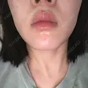 医療脱毛（顔） 共立美容外科 立川院 BEFORE サムネイル用