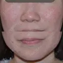 ピーリング（ニキビ・毛穴） / 美肌レーザー NEO Skin Clinic恵比寿 BEFORE サムネイル用