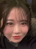 二重埋没 大塚美容形成外科 銀座本院 BEFORE サムネイル用