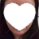 ヒアルロン酸注入（あご） Next Tokyo Clinic BEFORE サムネイル用
